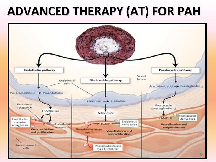 ADVANCED THERAPY (AT) FOR PAH 49 ADVANCED THERAPY (AT) FOR PAH 49