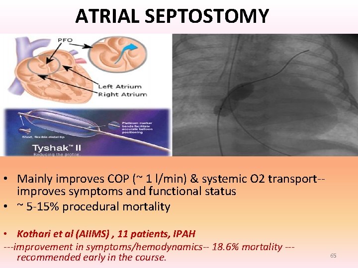 ATRIAL SEPTOSTOMY 1) In severe intractable RHF with syncopal symptoms on maximal advanced PAH ATRIAL SEPTOSTOMY 1) In severe intractable RHF with syncopal symptoms on maximal advanced PAH