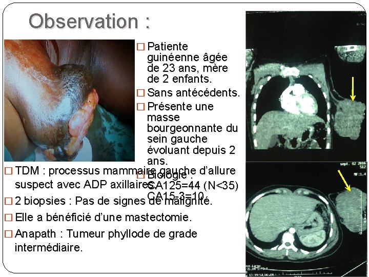 Observation : � Patiente guinéenne âgée de 23 ans, mère de 2 enfants. �
