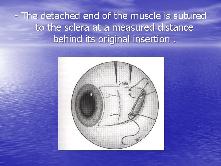 - The detached end of the muscle is sutured to the sclera at a