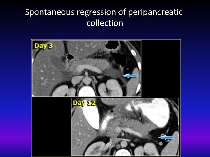 Spontaneous regression of peripancreatic collection 