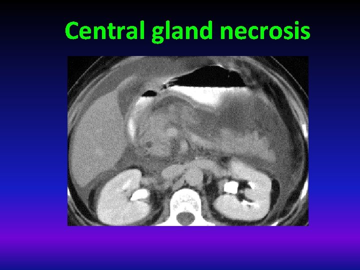 Central gland necrosis 