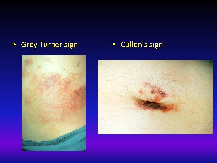  • Grey Turner sign • Cullen’s sign 