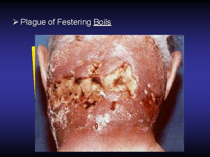 Ø Plague of Festering Boils Ø Plague of Festering Boils