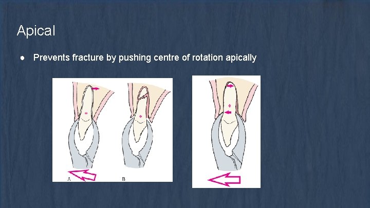 Apical ● Prevents fracture by pushing centre of rotation apically 