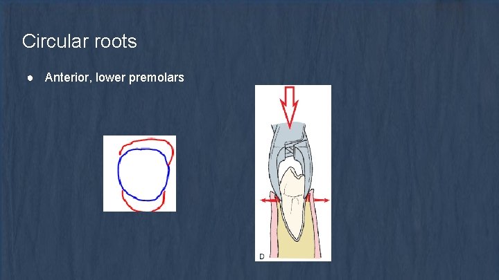 Circular roots ● Anterior, lower premolars 