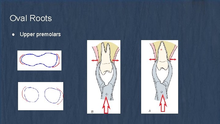 Oval Roots ● Upper premolars 