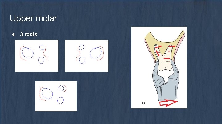 Upper molar ● 3 roots 