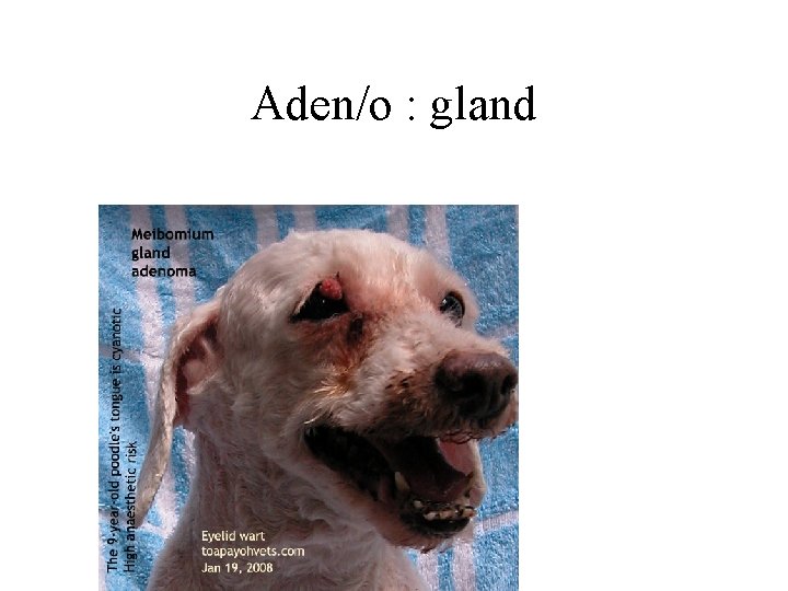 Aden/o : gland 