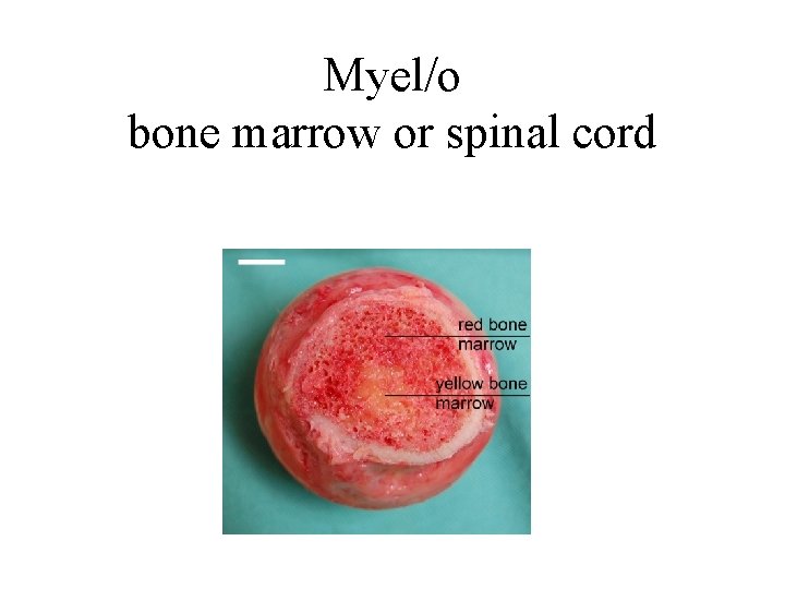 Myel/o bone marrow or spinal cord 