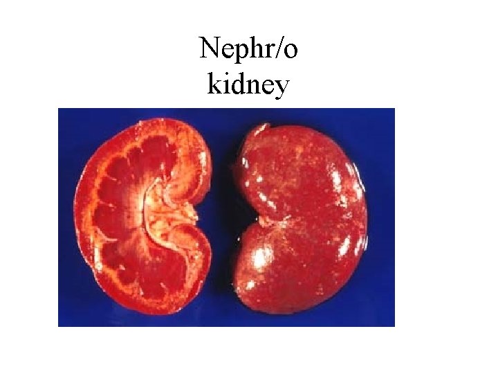 Nephr/o kidney 