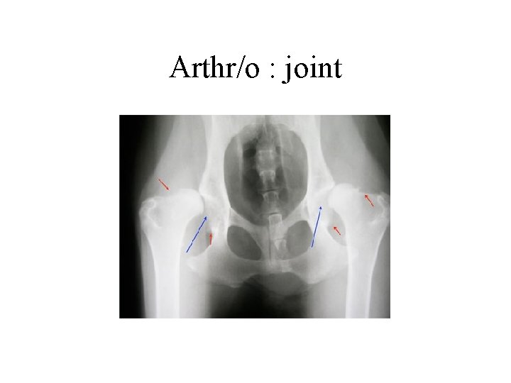 Arthr/o : joint 