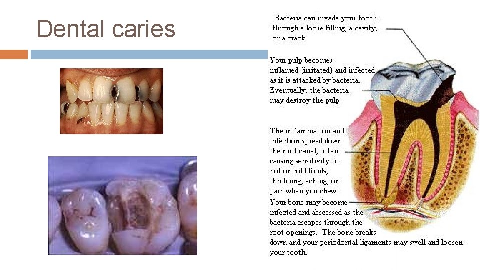 Dental caries 