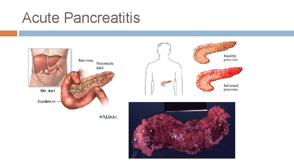 Acute Pancreatitis 