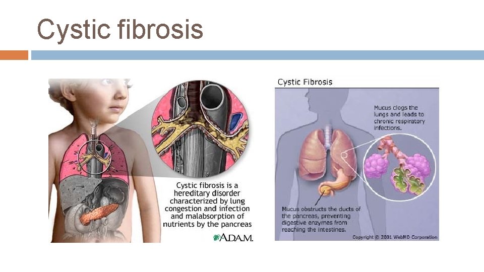 Cystic fibrosis 