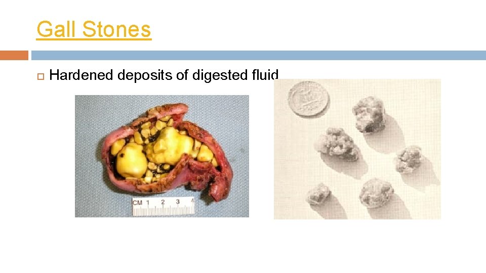 Gall Stones Hardened deposits of digested fluid 