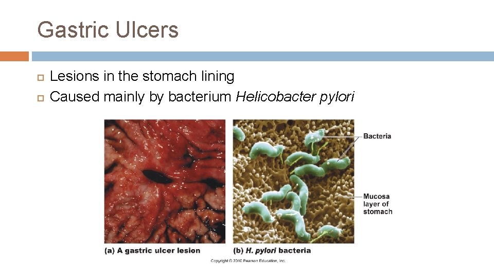 Gastric Ulcers Lesions in the stomach lining Caused mainly by bacterium Helicobacter pylori 