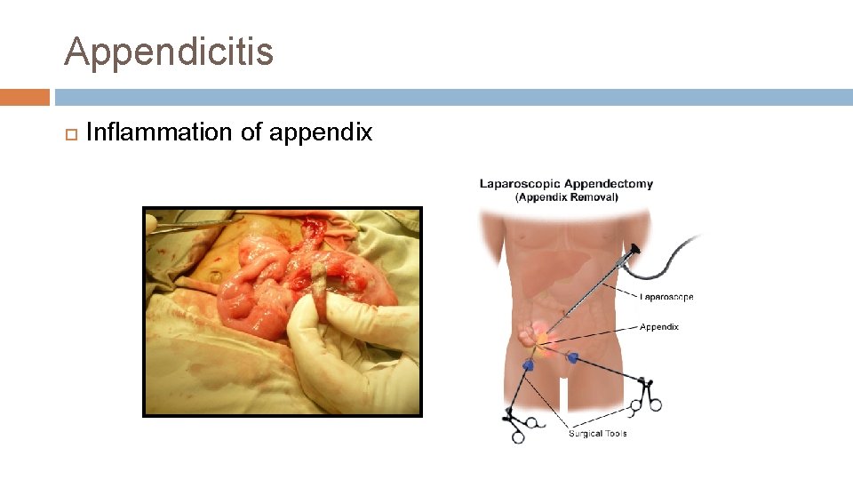 Appendicitis Inflammation of appendix 