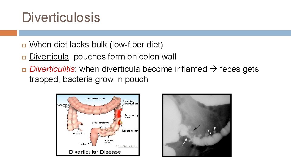 Diverticulosis When diet lacks bulk (low-fiber diet) Diverticula: pouches form on colon wall Diverticulitis: