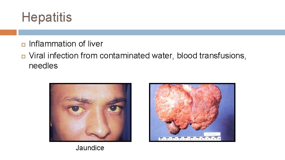 Hepatitis Inflammation of liver Viral infection from contaminated water, blood transfusions, needles Jaundice 