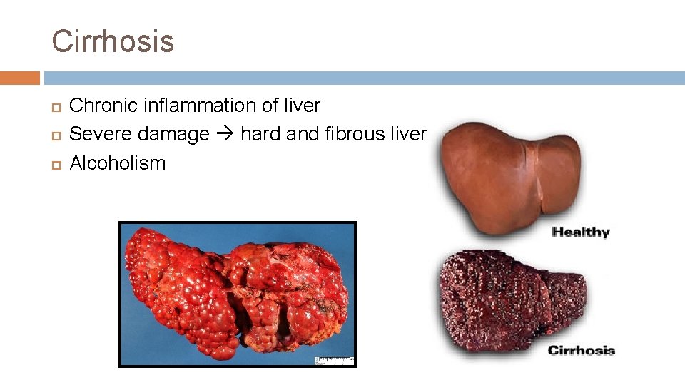 Cirrhosis Chronic inflammation of liver Severe damage hard and fibrous liver Alcoholism 