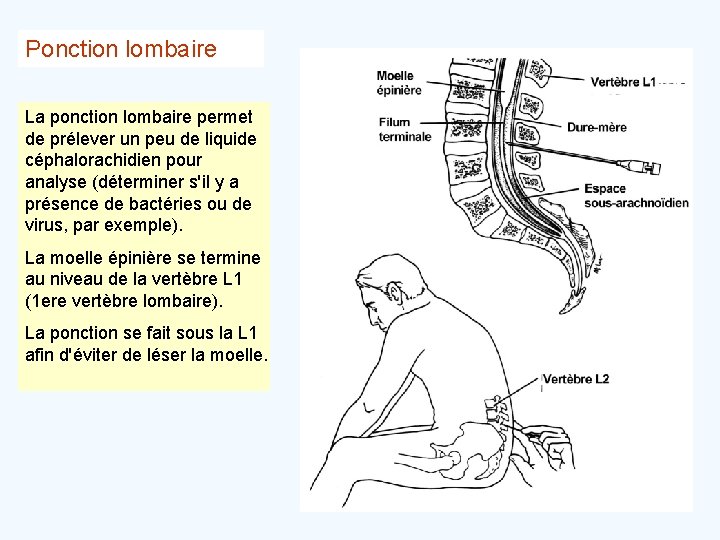 Ponction lombaire La ponction lombaire permet de prélever un peu de liquide céphalorachidien pour