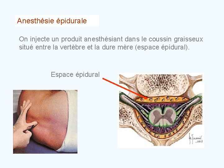 Anesthésie épidurale On injecte un produit anesthésiant dans le coussin graisseux situé entre la