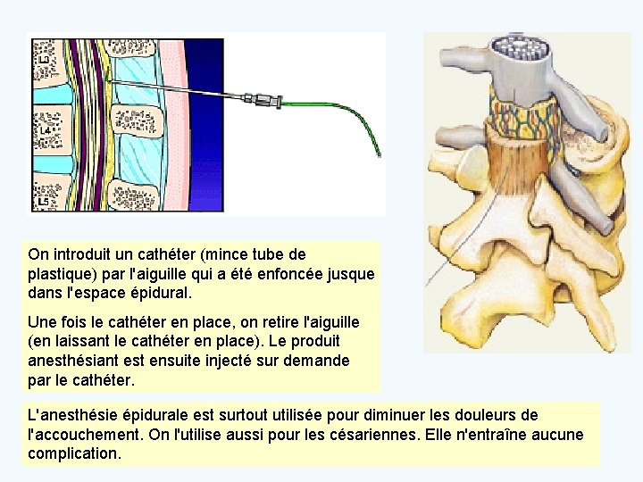 On introduit un cathéter (mince tube de plastique) par l'aiguille qui a été enfoncée