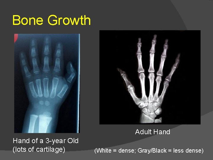 Bone Growth Adult Hand of a 3 -year Old (lots of cartilage) (White =