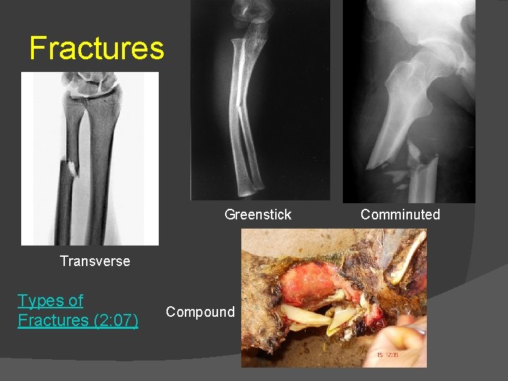 Fractures Greenstick Transverse Types of Fractures (2: 07) Compound Comminuted 