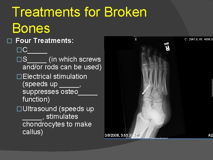 Treatments for Broken Bones � Four Treatments: �C_____ �S_____ (in which screws and/or rods