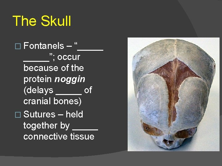 The Skull � Fontanels – “_____”; occur because of the protein noggin (delays _____