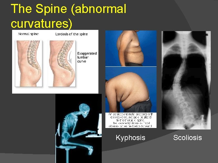 The Spine (abnormal curvatures) Kyphosis Scoliosis 