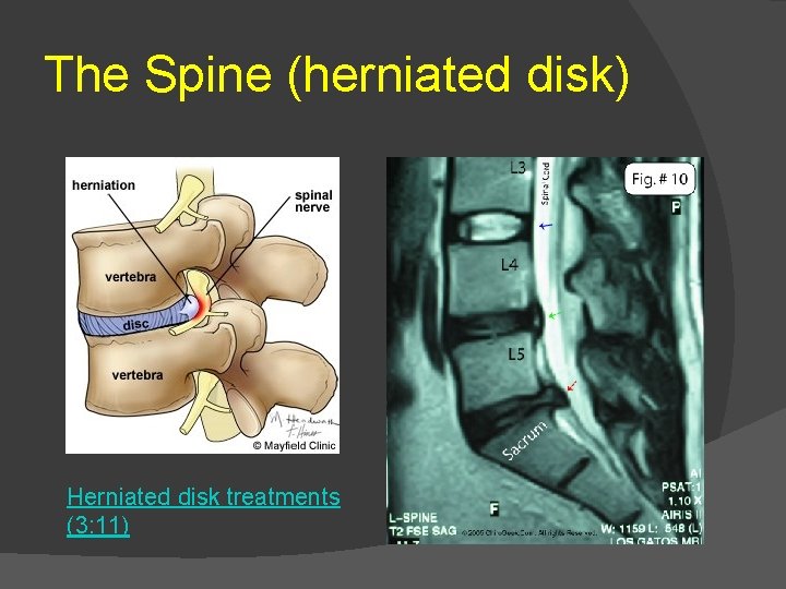 The Spine (herniated disk) Herniated disk treatments (3: 11) 