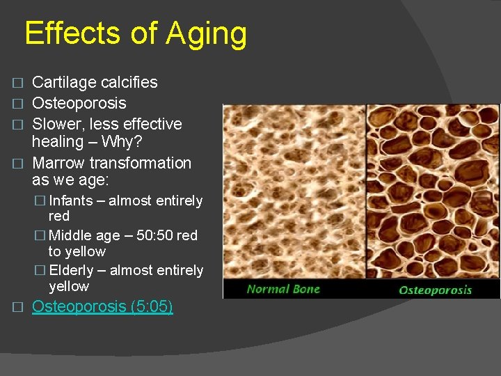 Effects of Aging Cartilage calcifies � Osteoporosis � Slower, less effective healing – Why?