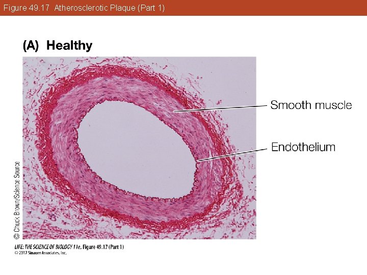 Figure 49. 17 Atherosclerotic Plaque (Part 1) 