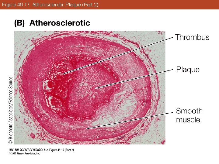 Figure 49. 17 Atherosclerotic Plaque (Part 2) 
