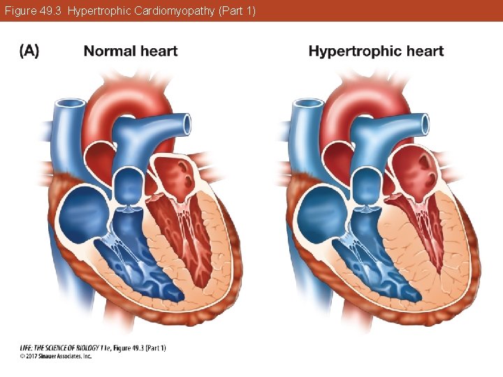 Figure 49. 3 Hypertrophic Cardiomyopathy (Part 1) 