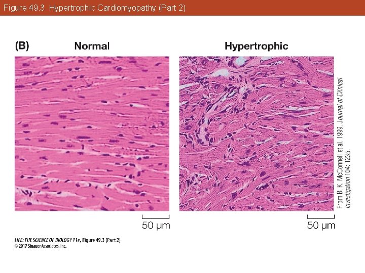 Figure 49. 3 Hypertrophic Cardiomyopathy (Part 2) 