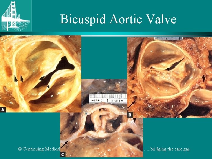 Bicuspid Aortic Valve © Continuing Medical Implementation …. . . bridging the care gap