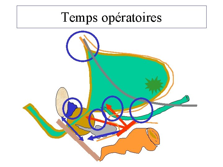 Temps opératoires 