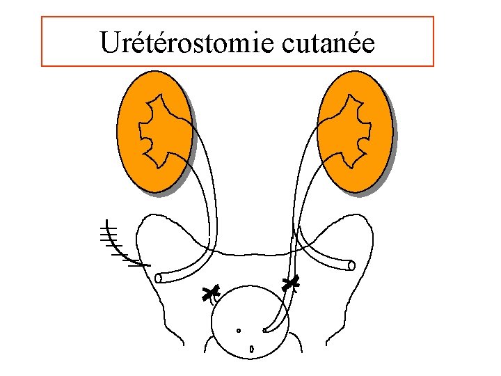 Urétérostomie cutanée 