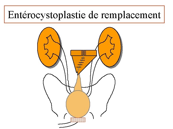 Entérocystoplastie de remplacement 