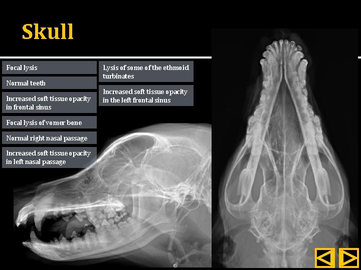 Skull Focal lysis Normal teeth Increased soft tissue opacity in frontal sinus Focal lysis