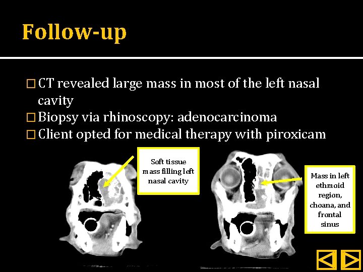 Follow-up � CT revealed large mass in most of the left nasal cavity �