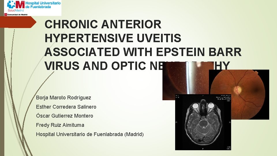 CHRONIC ANTERIOR HYPERTENSIVE UVEITIS ASSOCIATED WITH EPSTEIN BARR VIRUS AND OPTIC NEUROPATHY Borja Maroto