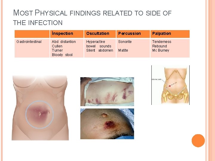MOST PHYSICAL FINDINGS RELATED TO SIDE OF THE INFECTION Gastrointestinal İnspection Oscultation Percussion Palpation