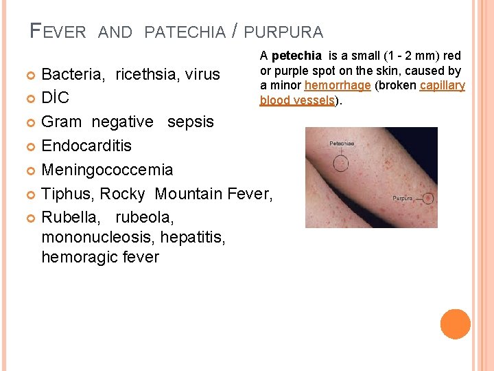 FEVER AND PATECHIA / PURPURA A petechia is a small (1 - 2 mm)