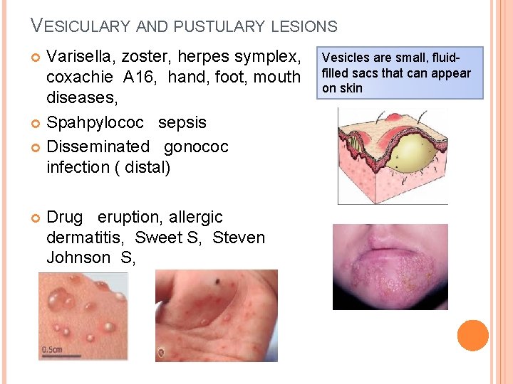 VESICULARY AND PUSTULARY LESIONS Varisella, zoster, herpes symplex, coxachie A 16, hand, foot, mouth