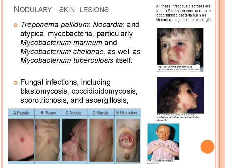 NODULARY SKIN LESIONS Treponema pallidum; Nocardia; and atypical mycobacteria, particularly Mycobacterium marinum and Mycobacterium